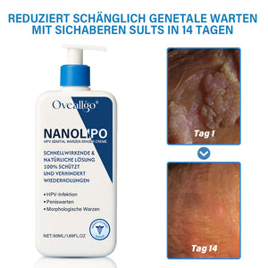 Oveallgo® NanoLipo Genital warzen-Eraser creme Promax