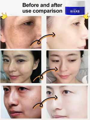 (BUY 1 GET 2) Spot Fading Urea Cream