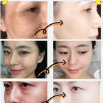 🎁LAST DAY 50% OFF🎁Spot Fading Urea Cream