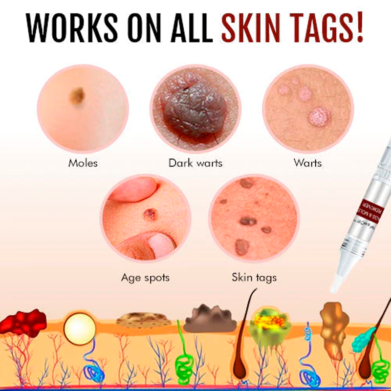 WipeOff™ Tags & Moles Remover